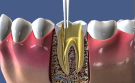 Есть вопрос: почему болит зуб, если нерв удалён?